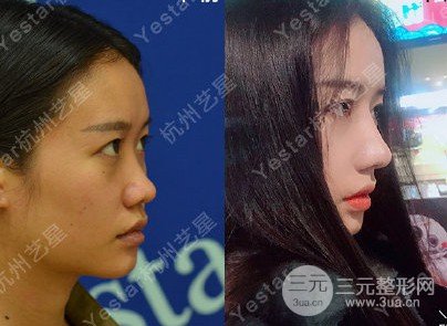 不開(kāi)刀隆鼻是什么技術(shù)