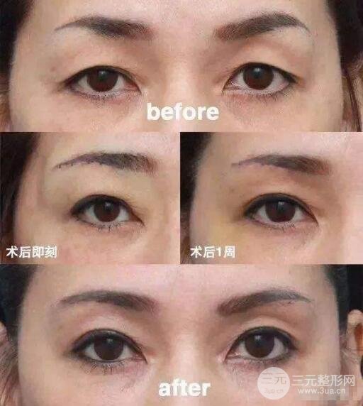 提眉術(shù)前后對比照片