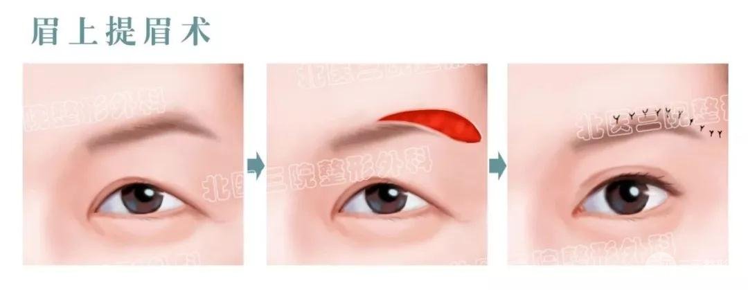 提眉術(shù)前后對比照片