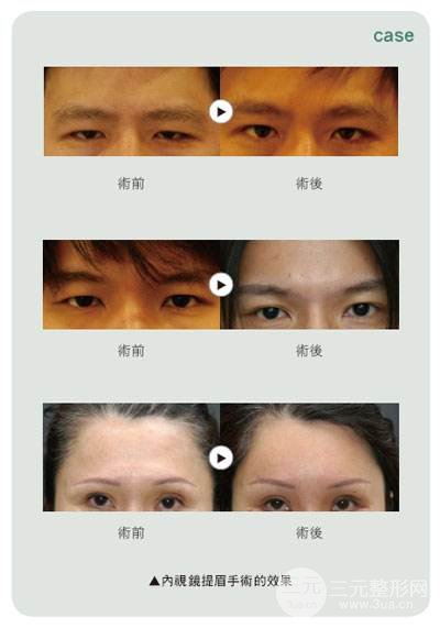 提眉術(shù)前后對比照片