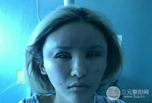 芭比眼睛雙眼皮圖片