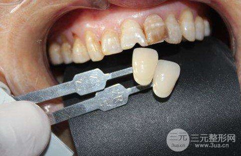 烤瓷牙的壽命是幾年