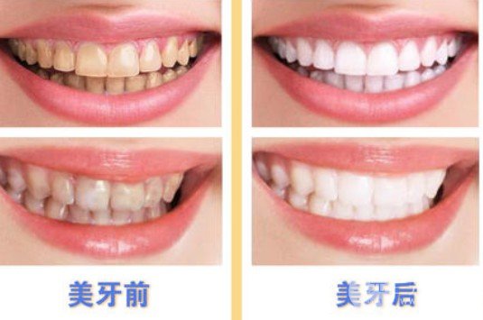 烤瓷牙的壽命是幾年