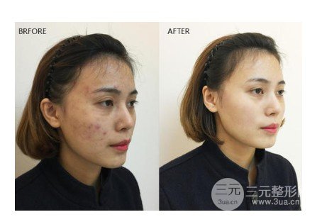 彩光去雀斑會結(jié)痂嗎