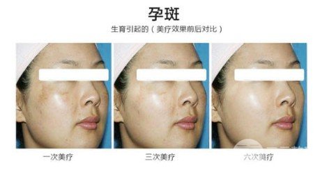 彩光去雀斑會結(jié)痂嗎