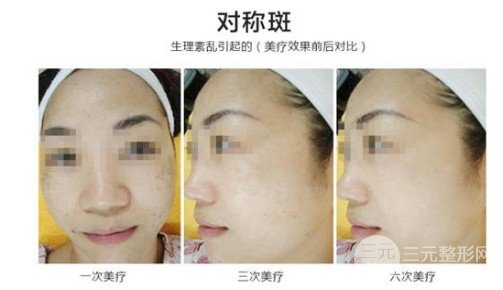 彩光去雀斑會結(jié)痂嗎