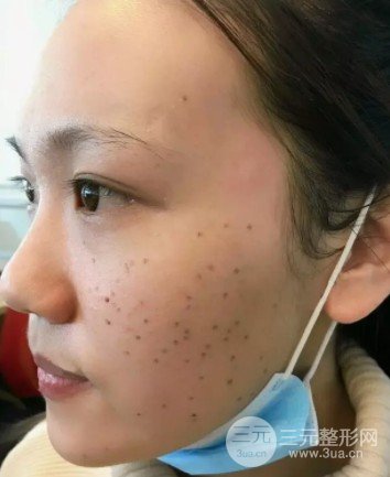 彩光去雀斑會結(jié)痂嗎