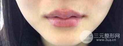 M唇手術(shù)對(duì)比照：