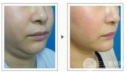 面部吸脂會反彈嗎