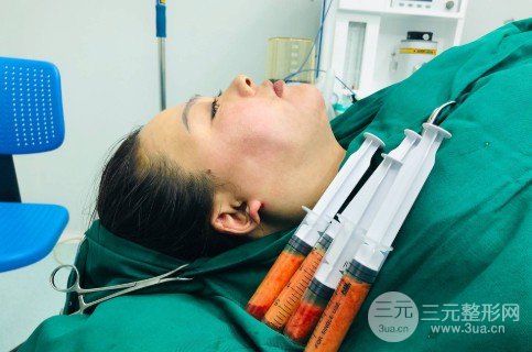 面部吸脂會反彈嗎