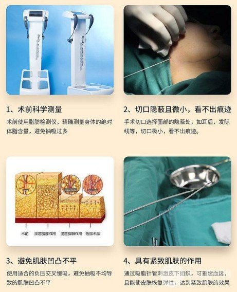 面部吸脂會反彈嗎