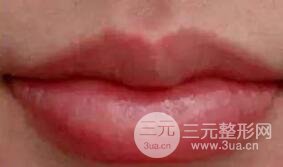 M唇手術(shù)步驟：