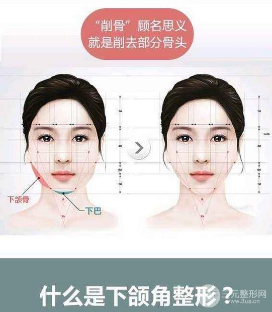 國字臉削骨價格一般多少錢？手術(shù)注意事項以及案例圖分享~