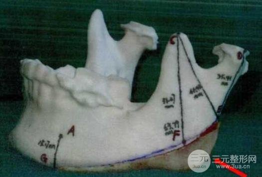 國字臉削骨價格一般多少錢？手術(shù)注意事項以及案例圖分享~
