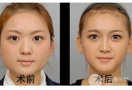 注射瘦臉多久打一次