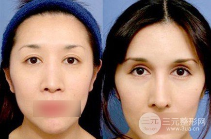 做雙眼皮開眼角注意事項