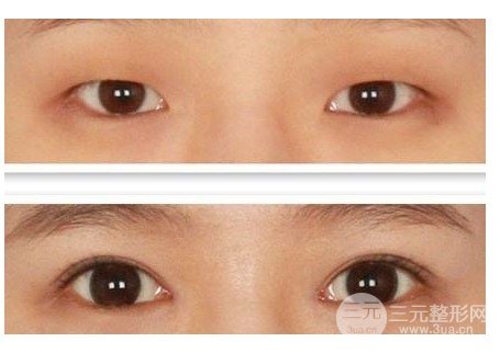 做雙眼皮開眼角注意事項