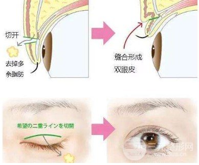 做雙眼皮開眼角注意事項