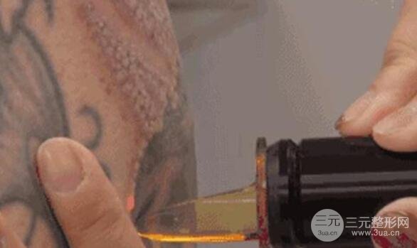 洗掉紋身的費(fèi)用?