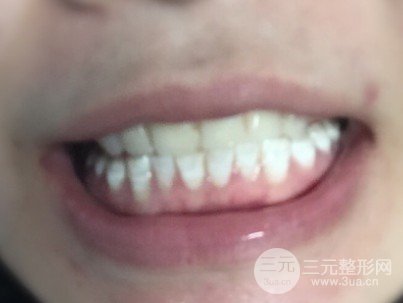 烤瓷牙的價(jià)格多少