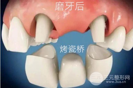 烤瓷牙的價(jià)格多少