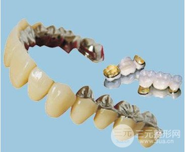 烤瓷牙一般費(fèi)用多少