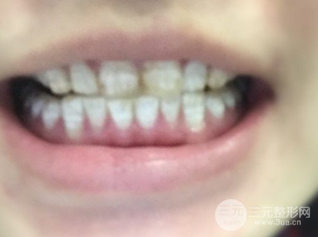 烤瓷牙一般費(fèi)用多少