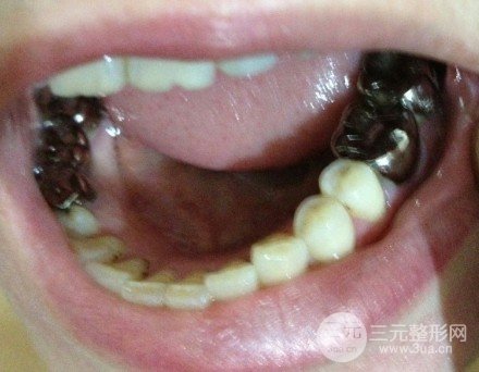 烤瓷牙一般費(fèi)用多少