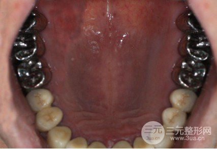 烤瓷牙一般費(fèi)用多少