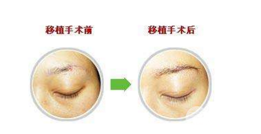 種植眉毛前后圖片