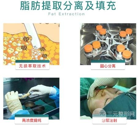 脂肪填充眼窩的特點(diǎn)