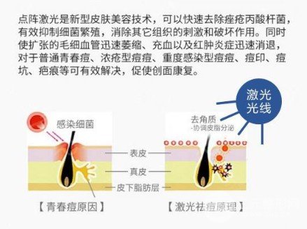 激光去痘印價(jià)格多少