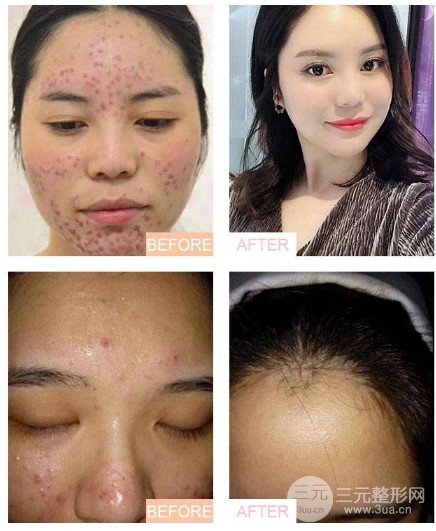 激光去痘印價(jià)格多少