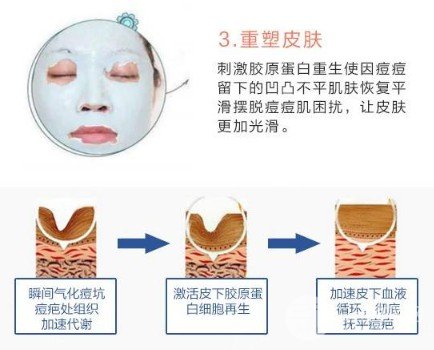 激光去痘印價(jià)格多少