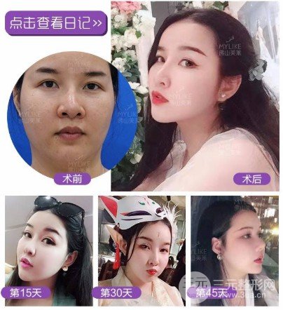 面部吸脂會(huì)反彈嗎