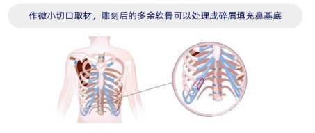 自體軟骨隆鼻的價(jià)格貴嗎