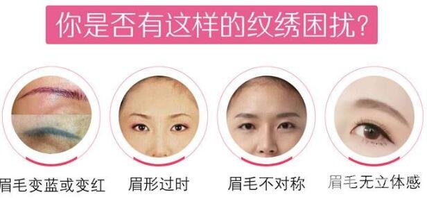 激光洗眉手術(shù)