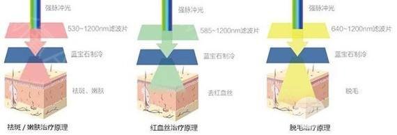 激光洗眉多少錢
