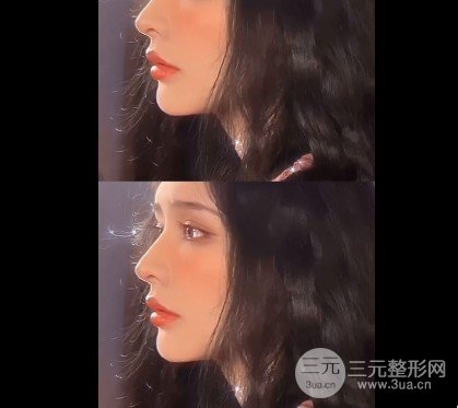 眼袋切除手術能保幾年