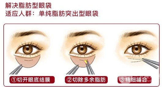 眼袋切除手術能保幾年