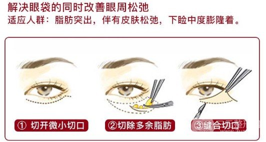 眼袋切除手術能保幾年