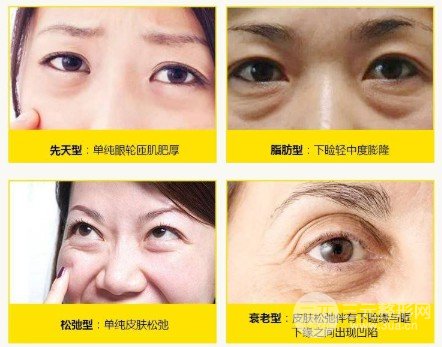 眼袋切除術(shù)后多久恢復(fù)