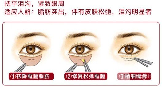 眼袋切除術(shù)后多久恢復(fù)