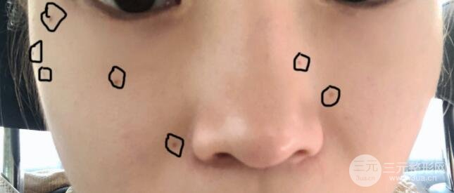 點(diǎn)痣前的照片