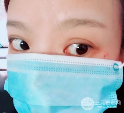 點(diǎn)痣的過程