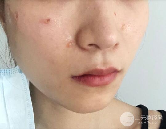 點(diǎn)痣后1-7天