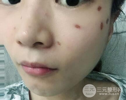 點(diǎn)痣后1-7天