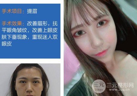 切眉除皺多少錢