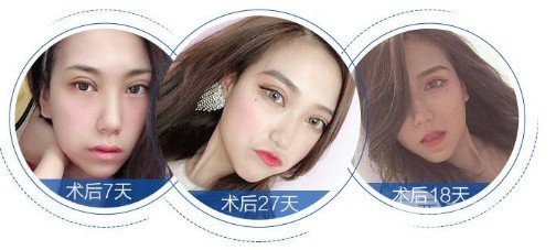 切眉除皺多少錢