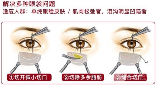 眼袋切除術(shù)需要多少錢